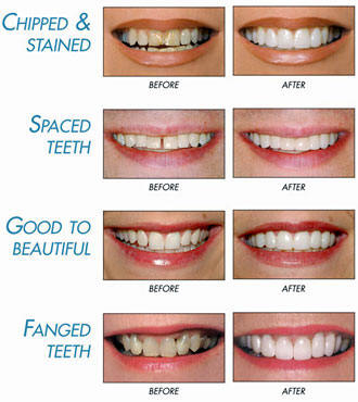 cosmetic dentistry gaps between teeth
